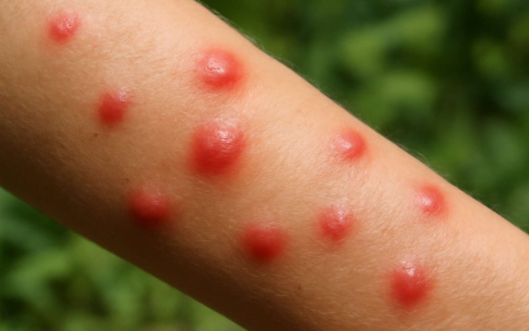 Effective Ways to Soothe and Treat Insects Bites on Skin for Fast Relief